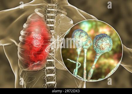 Pulmonary mucormycosis (or zygomycosis), a lung disease caused by fungi Mucor, also known as black fungus, with close-up view of the fungi, computer i Stock Photo