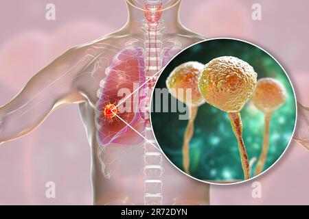 Pulmonary mucormycosis (or zygomycosis), a lung disease caused by fungi Mucor, also known as black fungus, with close-up view of the fungi, computer i Stock Photo