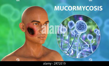 Cutaneous mucormycosis, a disease caused by Mucor fungi, computer artwork. Mucor mold is also known as black fungus, bread mold fungi. Mucor sp. fungi Stock Photo