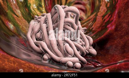 Round worms in human intestine, computer artwork. Roundworms, or nematodes, include numerous free-living and pathogenic species. Nematodes that common Stock Photo
