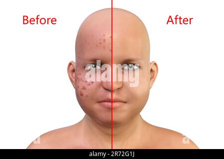 Acne vulgaris on an overweight teenage boy's face, computer illustration showing the boy's skin before and after treatment. Acne is a general name giv Stock Photo