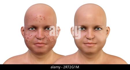 Acne vulgaris on an overweight teenage boy's face, computer illustration showing the boy's skin before and after treatment. Acne is a general name giv Stock Photo
