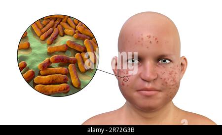 Acne vulgaris on an overweight teenage boy's face and close-up view of bacteria that cause acne, computer illustration. Acne is a general name given t Stock Photo