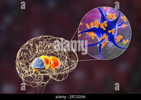 Anti-basal ganglia antibodies (ABGA). Conceptual computer illustration showing molecules of immunoglobulins attacking dorsal striatum highlighted in t Stock Photo