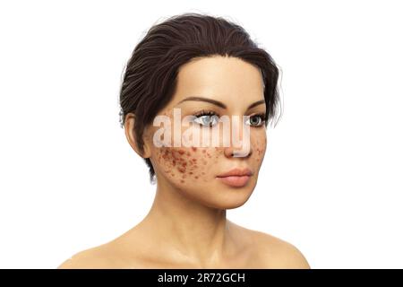 Acne vulgaris on a teenage girl's face, computer illustration. Acne is a general name given to a skin disorder in which the sebaceous glands become in Stock Photo