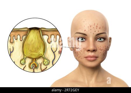 Acne vulgaris on a teenage girl's face and close-up view of bacteria that cause acne, computer illustration. Acne is a general name given to a skin di Stock Photo