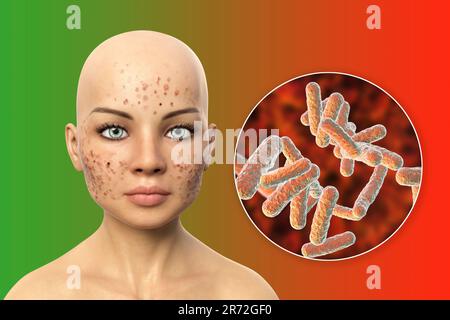 Acne vulgaris on a teenage girl's face and close-up view of bacteria that cause acne, computer illustration. Acne is a general name given to a skin di Stock Photo