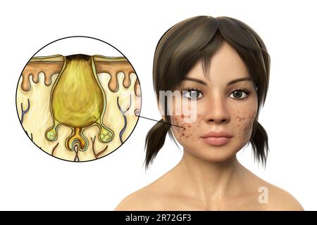 Acne vulgaris on a teenage girl's face and close-up view of bacteria that cause acne, computer illustration. Acne is a general name given to a skin di Stock Photo