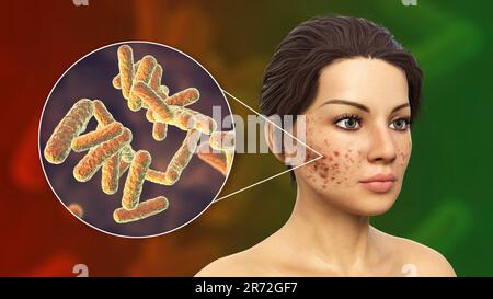 Acne vulgaris on a teenage girl's face and close-up view of bacteria that cause acne, computer illustration. Acne is a general name given to a skin di Stock Photo