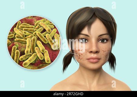 Acne vulgaris on a teenage girl's face and close-up view of bacteria that cause acne, computer illustration. Acne is a general name given to a skin di Stock Photo