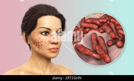 Acne vulgaris on a teenage girl's face and close-up view of bacteria that cause acne, computer illustration. Acne is a general name given to a skin di Stock Photo