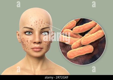 Acne vulgaris on a teenage girl's face and close-up view of bacteria that cause acne, computer illustration. Acne is a general name given to a skin di Stock Photo