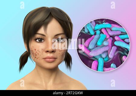 Acne vulgaris on a teenage girl's face and close-up view of bacteria that cause acne, computer illustration. Acne is a general name given to a skin di Stock Photo