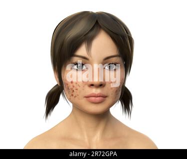 Acne vulgaris on a teenage girl's face, computer illustration. Acne is a general name given to a skin disorder in which the sebaceous glands become in Stock Photo