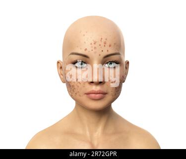 Acne vulgaris on a teenage girl's face, computer illustration. Acne is a general name given to a skin disorder in which the sebaceous glands become in Stock Photo