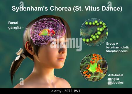 Sydenham's chorea, an autoimmune disease that results from Streptococcus infection, formation of anti-neuronal antibodies damaging brain basal ganglia Stock Photo