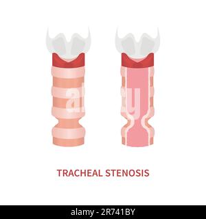 Trachea narrowing awareness icon of tracheal stenosis Stock Vector
