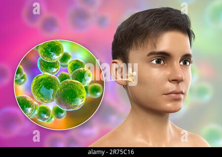 Otitis media ear infection caused by Moraxella catarrhalis bacteria, conceptual computer illustration. Acute otitis media is the inflammation of the m Stock Photo