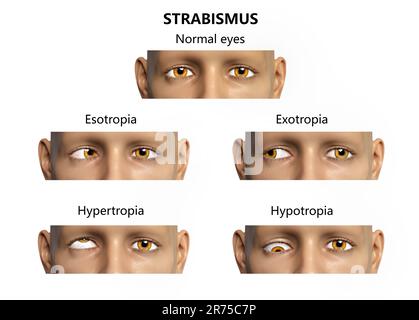 Childhood strabismus types, computer illustration. Stock Photo