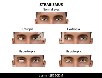 Childhood strabismus types, computer illustration. Stock Photo