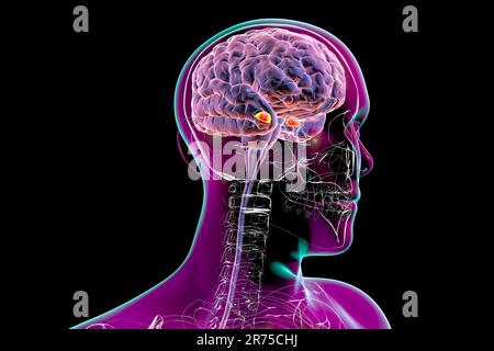 Amygdala, also known as corpus amygdaloideum, in the brain, computer illustration. Two almond-shaped clusters of nuclei within the temporal lobes, par Stock Photo