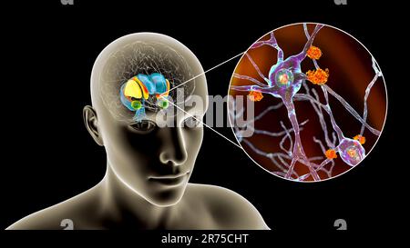 Dorsal striatum and lateral ventricles in the brain of a person with Huntington's disease, computer illustration. Huntington's diseases an autosomal d Stock Photo