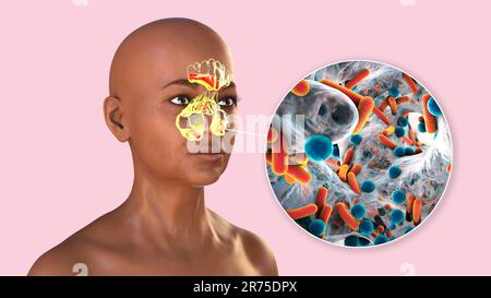 Sinusitis, inflammation of paranasal cavities. Computer illustration showing purulent inflammation of frontal, ethmoid, and maxillary sinuses, and clo Stock Photo