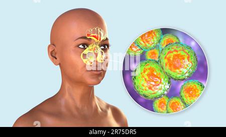 Moraxella catarrhalis bacteria as a cause of sinusitis. Computer illustration showing inflammation of frontal, ethmoid, and maxillary sinuses and clos Stock Photo