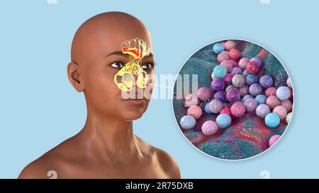 Staphylococcus aureus bacteria as a cause of sinusitis. Computer illustration showing inflammation of frontal, ethmoid, and maxillary sinuses and clos Stock Photo