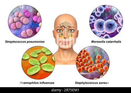 Anatomy of rhinosinusitis and bacteria that cause sinusitis. Streptococcus pneumoniae, Moraxella catarrhalis, Haemophilus influenzae, and Staphylococc Stock Photo