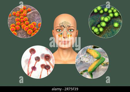 Anatomy of rhinosinusitis and microorganisms that cause sinusitis. Streptococcus pneumoniae, Streptococcus mutans, Aspergillus fumigatus, and Pseudomo Stock Photo