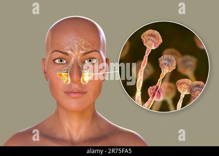 Aspergillus fungi as a cause of sinusitis. Computer illustration showing inflammation of maxillary sinuses, and close-up view of Aspergillus fungus. C Stock Photo