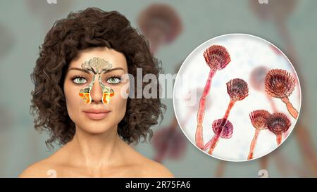 Aspergillus fungi as a cause of sinusitis. Computer illustration showing inflammation of maxillary sinuses, and close-up view of Aspergillus fungus. C Stock Photo