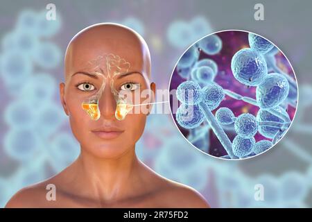Candida yeast fungi as a cause of sinusitis. Computer illustration showing inflammation of maxillary sinuses and close-up view of Candida fungi. Stock Photo