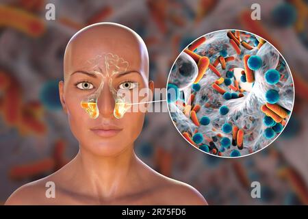 Sinusitis, inflammation of paranasal cavities. Computer illustration showing purulent inflammation of maxillary sinuses and close-up view of bacteria Stock Photo