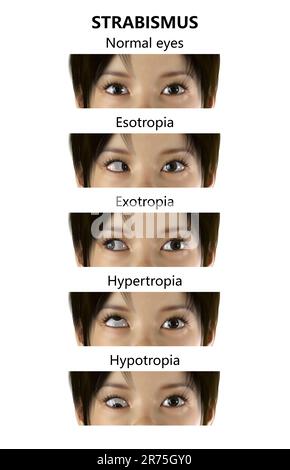 Childhood strabismus types, computer illustration. Stock Photo