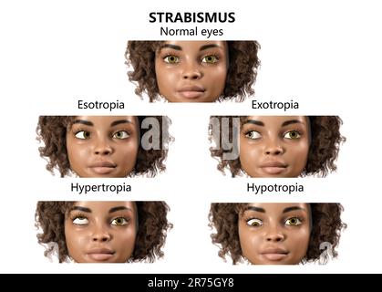 Childhood strabismus types, computer illustration. Stock Photo