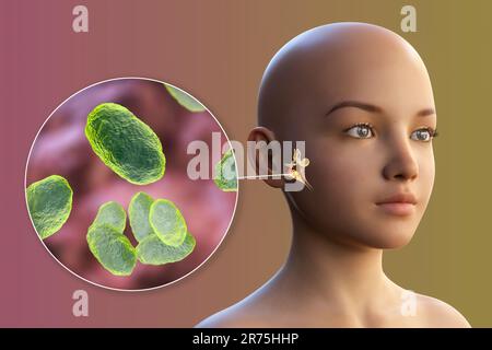 Otitis Media Ear Infection Caused By Moraxella Catarrhalis Bacteria ...