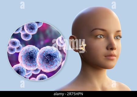 Otitis media ear infection caused by Moraxella catarrhalis bacteria, conceptual computer illustration. Acute otitis media is the inflammation of the m Stock Photo