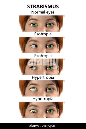 Childhood strabismus types, computer illustration. Stock Photo