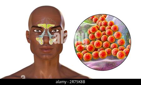Bacterial sinusitis, computer illustration. The sinuses are membrane-lined air-filled spaces in the bones of the face. Sinusitis, also known as a sinu Stock Photo