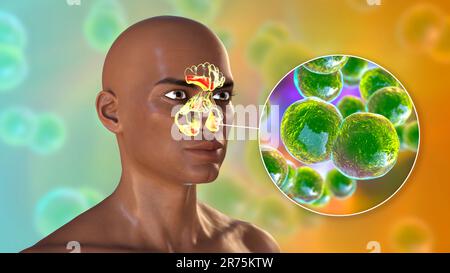 Bacterial sinusitis, computer illustration. The sinuses are membrane-lined air-filled spaces in the bones of the face. The frontal sinuses are above t Stock Photo