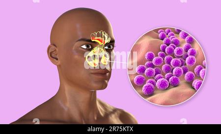 Bacterial sinusitis, computer illustration. The sinuses are membrane-lined air-filled spaces in the bones of the face. The frontal sinuses are above t Stock Photo