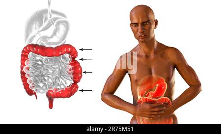 Abdominal pain and cramping in African man because of irritable bowel syndrome (IBS), conceptual computer illustration with highlighted intestine and Stock Photo