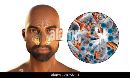 Sinusitis, inflammation of paranasal cavities. Computer illustration showing purulent inflammation of maxillary sinuses and close-up view of bacteria Stock Photo