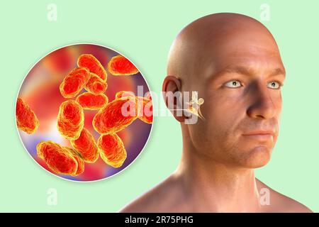 Otitis media ear infection caused by Haemophilus influenzae bacteria, computer illustration. Acute otitis media is the inflammation of the middle ear Stock Photo