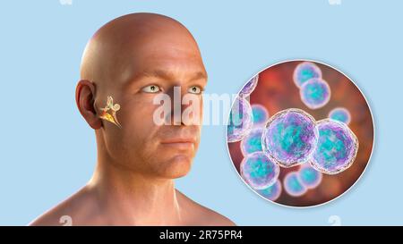 Otitis media ear infection caused by Moraxella catarrhalis bacteria, conceptual computer illustration. Acute otitis media is the inflammation of the m Stock Photo