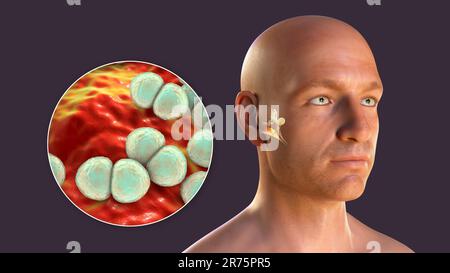 Otitis media ear infection caused by Streptococcus pneumoniae bacteria, conceptual computer illustration. Acute otitis media is the inflammation of th Stock Photo