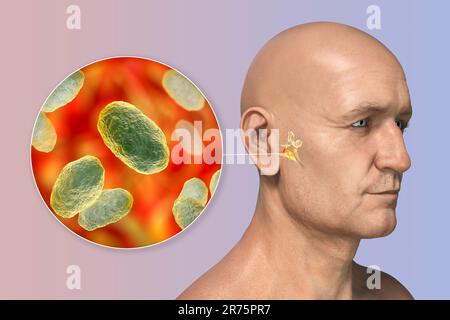 Otitis media ear infection caused by Haemophilus influenzae bacteria, computer illustration. Acute otitis media is the inflammation of the middle ear Stock Photo