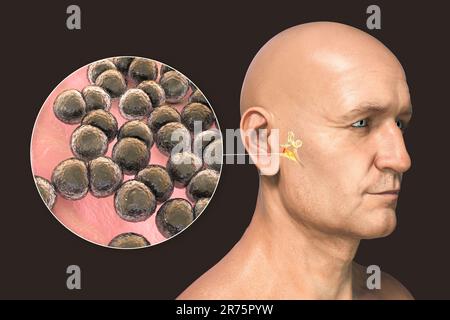 Otitis media ear infection caused by Streptococcus pneumoniae bacteria, conceptual computer illustration. Acute otitis media is the inflammation of th Stock Photo